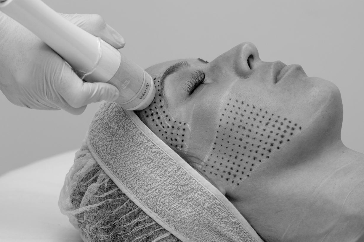 HIFU facial Sonofocus en Viña del Mar - AO Centro de Cirugía Plástica